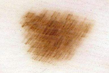 Wzorzec włókienkowy (ang. fibrillar pattern - FB)