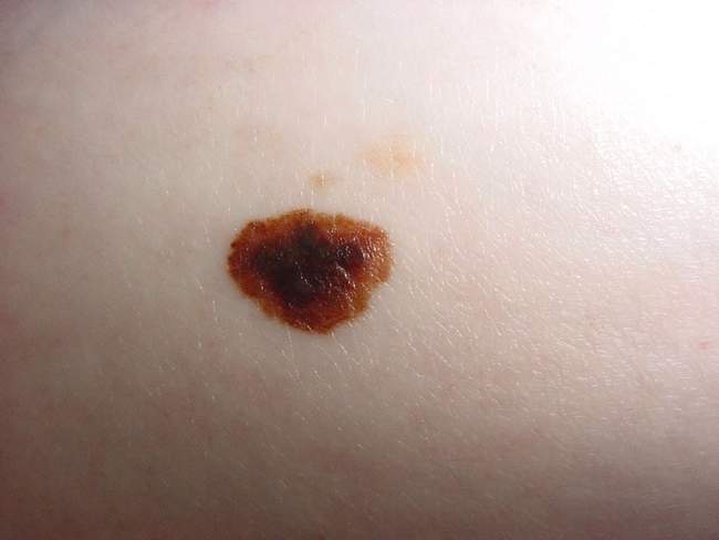 Czerniak skóry - melanoma nawrót choroby zdjęcie kliniczne