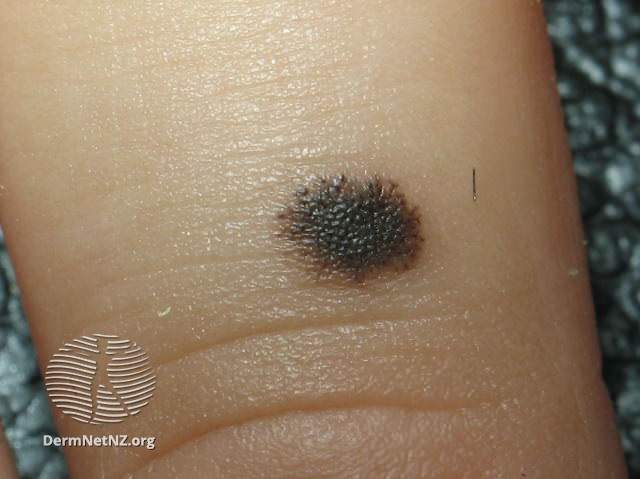 Znamię Reeda u dziecka. Źródło: www.dermnetnz.org