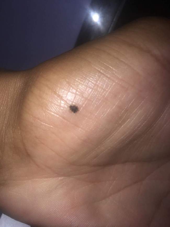 Czerniak akralny na dłoni