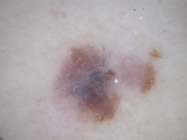 Czerniak skóry - melanoma kontrole po leczeniu badanie dermatoskopowe