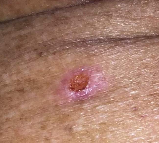 Rak podstawnokomórkowy - zaawansowany przypadek - zmiana wymagająca kompleksowego leczenia