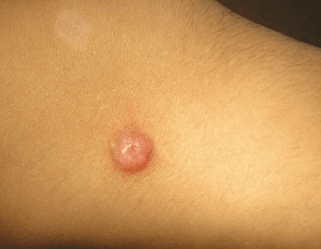 czerniak guzkowaty NM