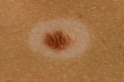 Znamię Suttona u dziecka. Źródło: www.gpnotebook.com