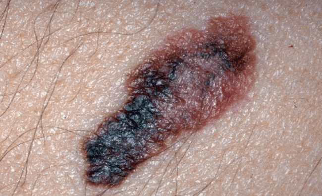 Czerniak złośliwy - melanoma zdjęcie kliniczne nowotwór barwnikowy