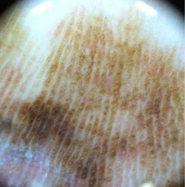 Linie równoległe na grzebieniach w lokalizacji akralnej