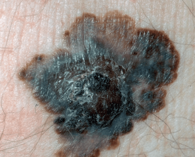 Czerniak złośliwy - melanoma zaawansowany nowotwór skóry zdjęcie dermatologiczne