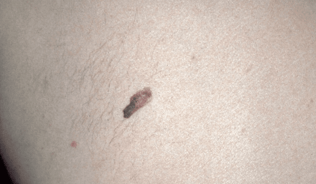 Czerniak złośliwy - melanoma zdjęcie medyczne niebezpieczny nowotwór skóry