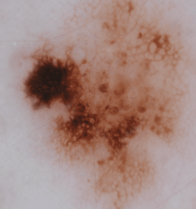 Czerniak złośliwy - melanoma zdjęcie medyczne złośliwy nowotwór