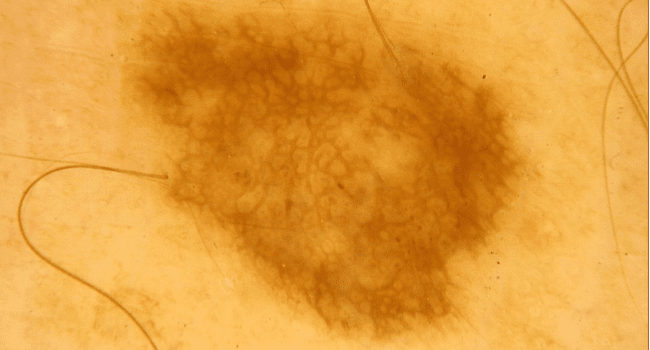 Zwykłe znamię barwnikowe - pieprzyk łagodny zdjęcie dermatologiczne