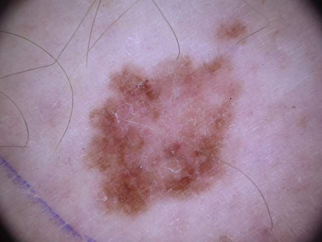 Czerniak skóry - melanoma zdjęcie dermatologiczne nowotwór barwnikowy