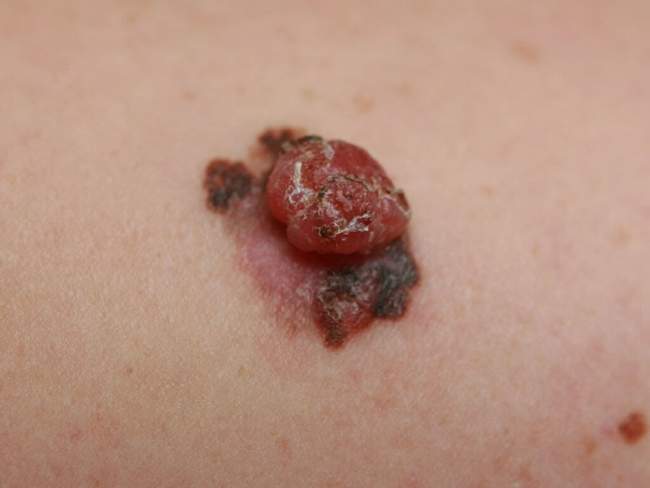 Czerniak guzkowaty - nodular melanoma zdjęcie dermatologiczne typ guzkowy
