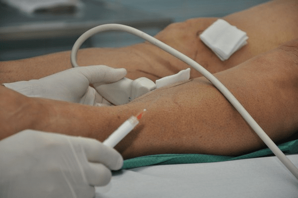 BACC - biopsja aspiracyjna cienkoigłowa celowana - biopsja, którą wspomaga USG