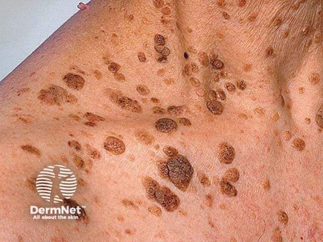 Brodawka łojotokowa - przykład zmiany