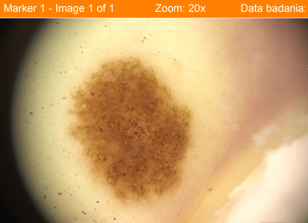 Znamię na palcu stopy prawej - zdjęcie mikroskopowe dermatoskopowe w powiększeniu wideodermatoskopia diagnostyka