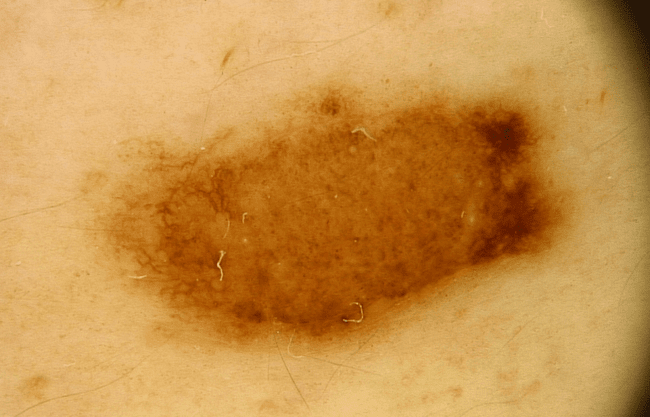 Wideodermatoskopia - zmapowane znamię nr 22.