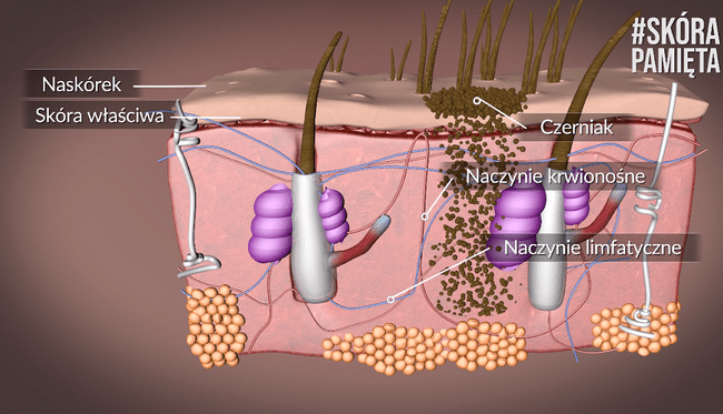Czerniak pokonuje kolejne warstwy skóry.