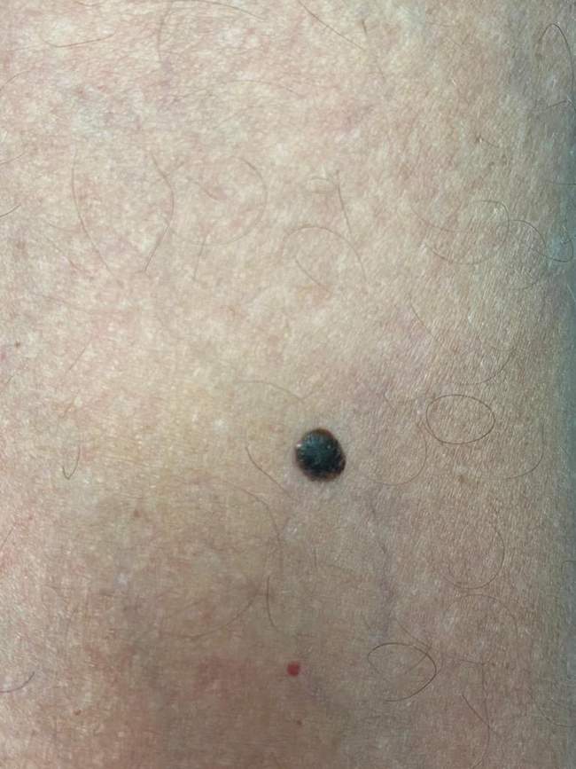 Zbliżenie brodawki łojotokowej