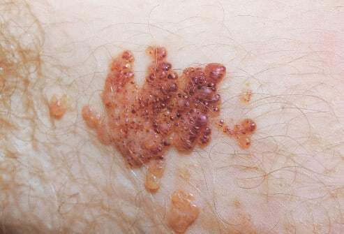 Naczyniak limfatyczny