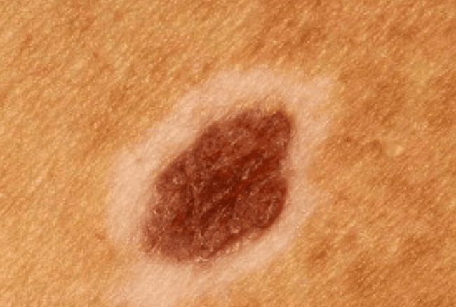 Znamię Suttona - halo nevus znamię z białą obwódką odbarwienie zdjęcie