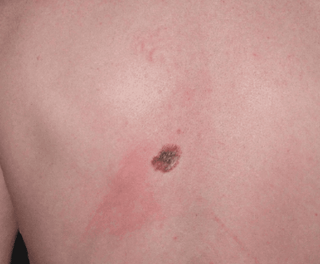 Czerniak szerzący się powierzchownie. Wzrost zmiany - objaw czerniaka.