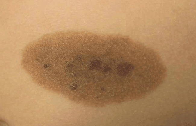 Duże znamię wrodzone - large congenital nevus zdjęcie dermatologiczne ryzyko czerniaka