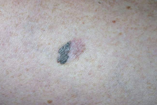 Czerniak z asymetrią