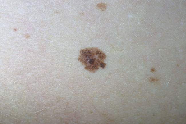 Czerniak złośliwy - melanoma zdjęcie kliniczne