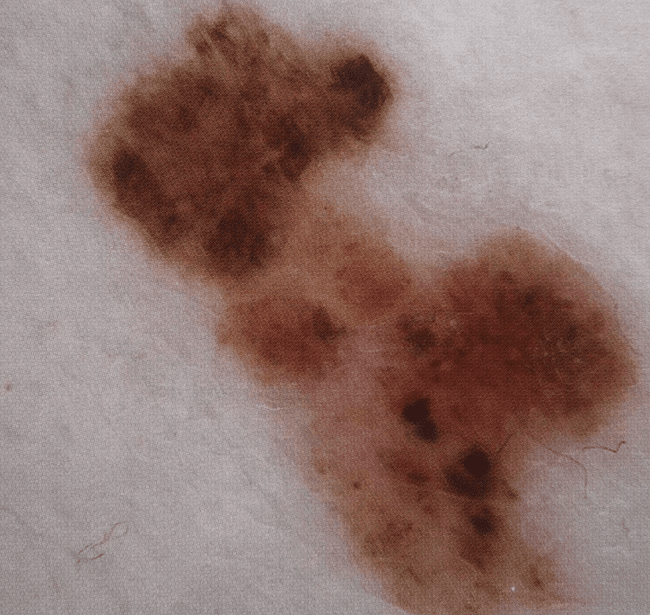 Czerniak złośliwy - melanoma objawy ABCDE zdjęcie medyczne przykład