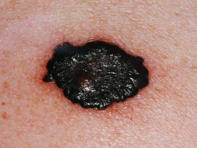 Czerniak skóry - melanoma zdjęcie medyczne usunięcie chirurgiczne badanie histopatologiczne