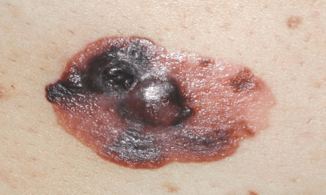 Czerniak złośliwy - melanoma zaawansowany czerniak krwawienie zdjęcie kliniczne