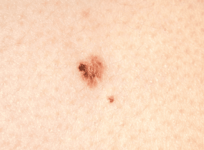 Czerniak złośliwy - melanoma zdjęcie dermatologiczne przykład kliniczny