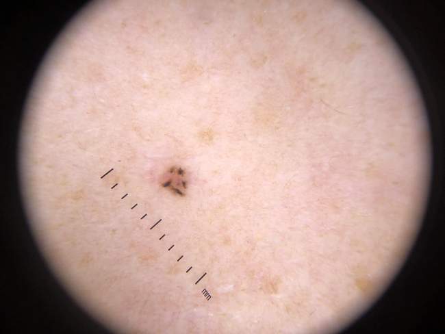 Rak podstawnokomórkowy - diagnostyka histopatologiczna - preparat mikroskopowy BCC