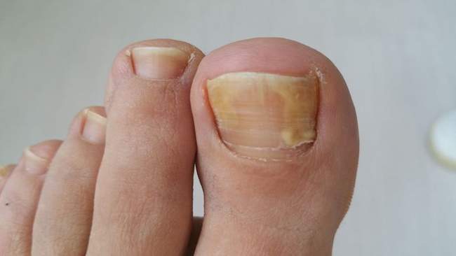 Grzybica paznokci - onychomycosis diagnostyka różnicowa czerniak podpaznokciowy