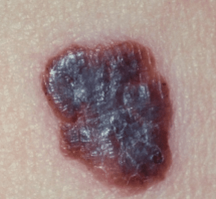 Czerniak złośliwy - melanoma może wyglądać jak naderwany pieprzyk