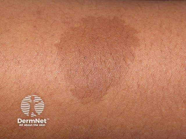 Łagodne znamię barwnikowe - pieprzyk