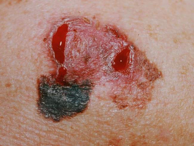 Czerniak skóry - melanoma zdjęcie medyczne nowotwór barwnikowy przykład