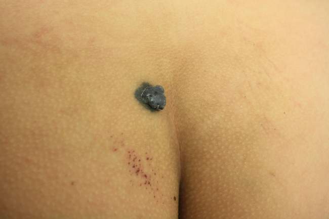 Znamię błękitne - blue nevus diagnostyka różnicowa czerniak badanie histopatologiczne