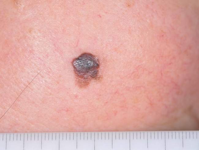 Czerniak skóry - melanoma zdjęcie dermatologiczne przykład kliniczny