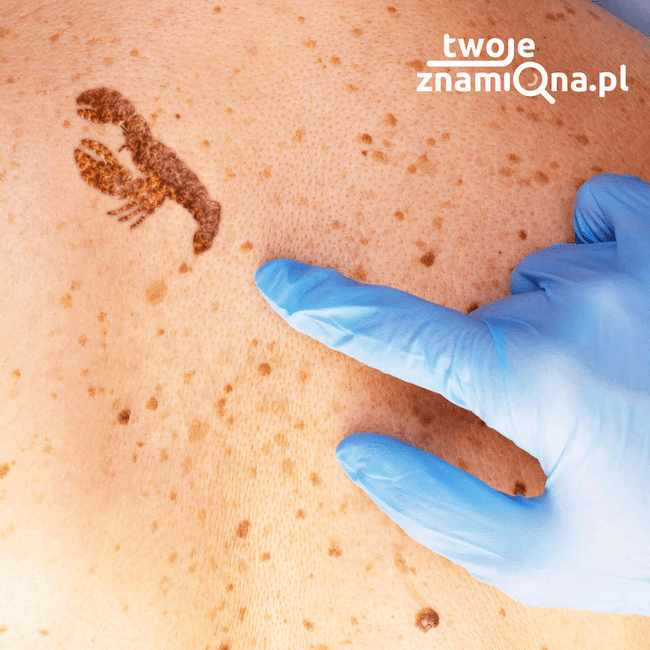 Ogólnopolskie Centrum Diagnostyki Znamion Twoje Znamiona