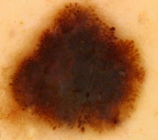 Czerniak u pacjenta z zespołem znamion dysplastycznych.