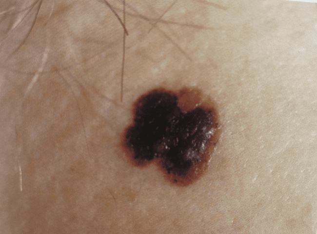 Czerniak złośliwy - melanoma asymetria nieregularne brzegi ABCDE zdjęcie medyczne