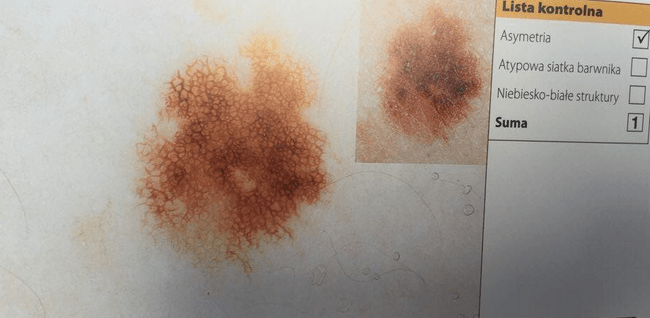 Znamię - ocena na podstawie 3-punktowej skali dermatoskopowej. (Dermatoskopia - H.P. Soyer; G. Argenziano; R. Hofmann-Wallenhof; I. Zalaudek)