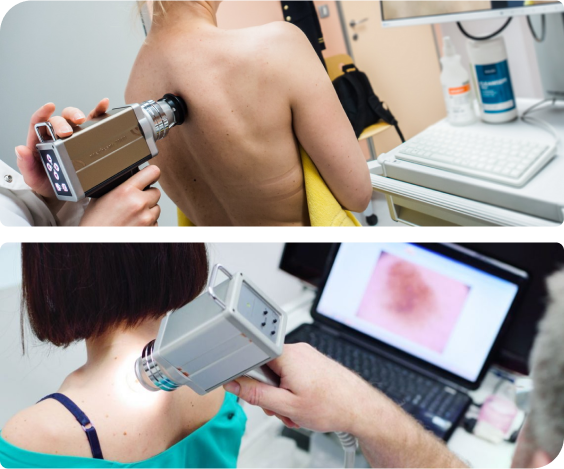 Badanie wideodermatoskopowe pleców